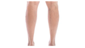 most effective varicose vein treatment